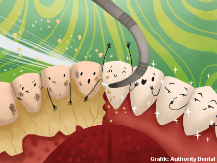 Zahnstein löst sich durch starke Ultraschallgeräte von der Zahnoberfläche